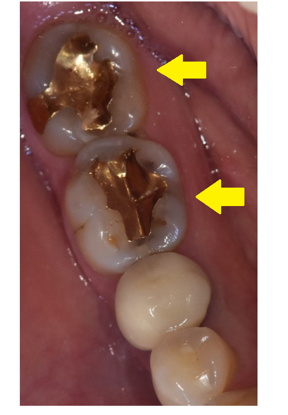 치아 사이 충치 원데이 인레이 하루만에 끝낼 수가 있을까? 관련 이미지 1