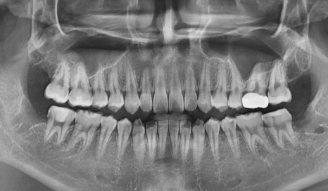 상일동 사랑니 매복 방치하다 옆 치아까지 망가진 실제 사례 관련 이미지 13