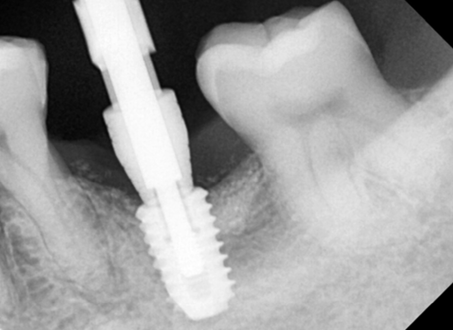 고덕동치과 서울바르디치과 전치부 및 구치부 임플란트 치료증례 #9 관련 이미지 26