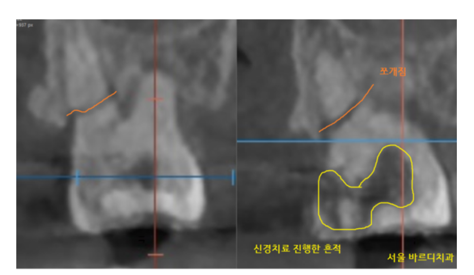 씹을때 찌릿 치아균열증후군 보이지 않아 위험합니다. 관련 이미지 3