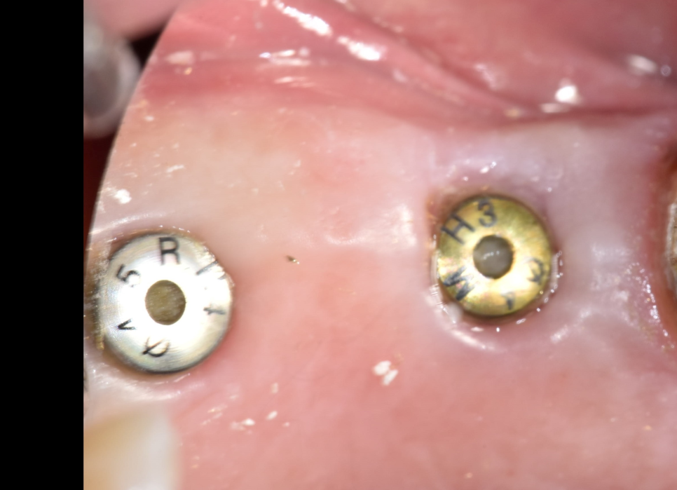 오늘 임플란트 심고, 내일 씹는게 가능하다고요?? (잔존골은 정답을 알고있다) 관련 이미지 5