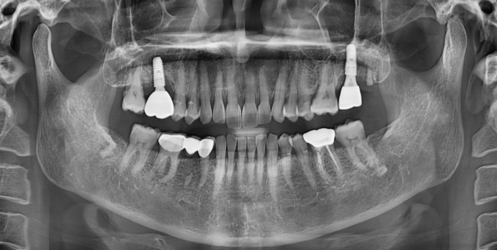 임플란트 볼씹힘 왜 생기고 어떻게 해결할까? 관련 이미지 6