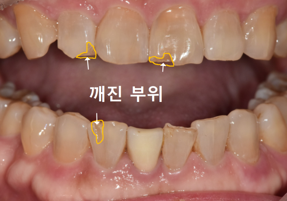 앞니 깨짐 치료 비용, 더이상 치과에 돈 낭비하기 싫다면? 깨지는 원인부터 알아야 합니다. 관련 이미지 7