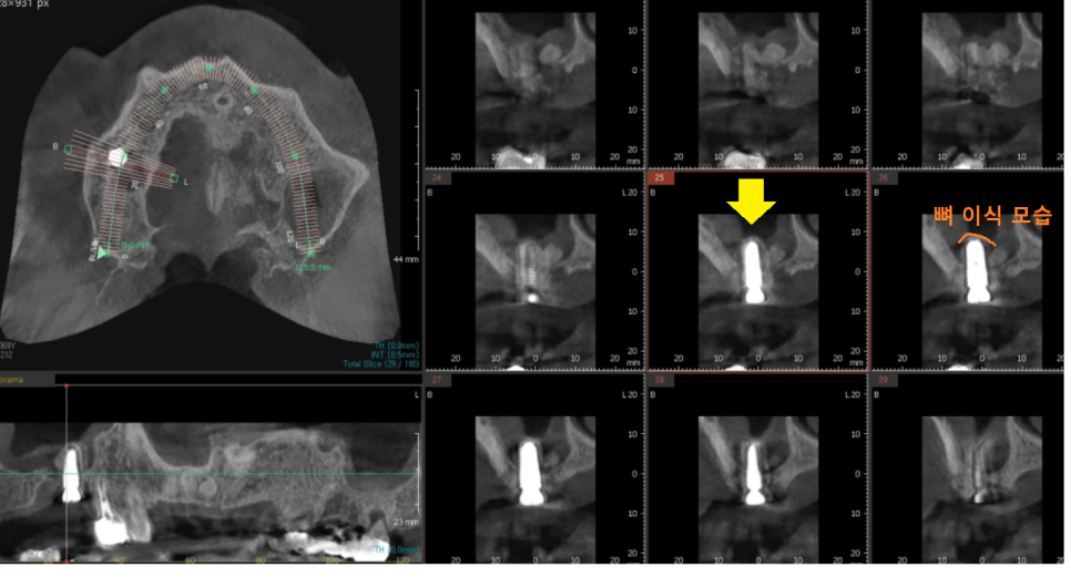 명일역 근처 치과 치아 뿌리 염증이 생겨서 고생하신 사연 관련 이미지 7