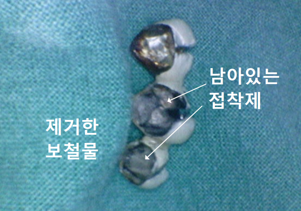 강동구 오래된 보철, 교체 시기는? 아프지 않은데 꼭 바꿔야 하나요? 관련 이미지 1