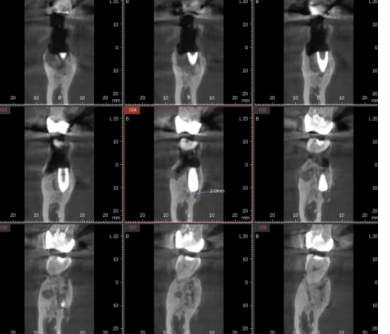 강일동 치과 잇몸뼈 녹음 발치 후 임플란트로 해결했습니다. 관련 이미지 7