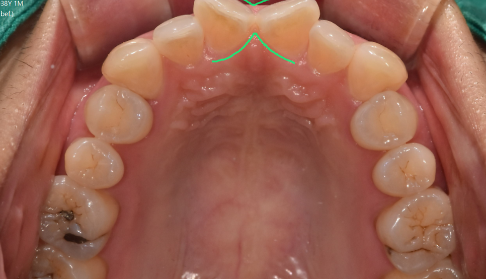 나비 모양 앞니 2가지 방법으로 개선 가능합니다. 관련 이미지 3