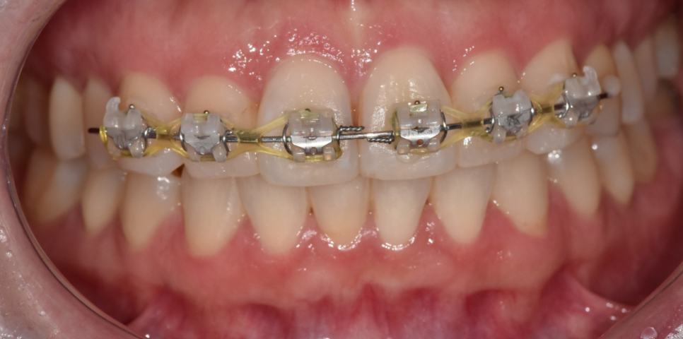 Separately or All at Once for Braces? Click Here if You’re Curious image 4