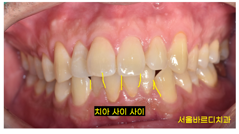 치아 교정 중 치간 삭제 치아를 깎는다고요??? 관련 이미지 1