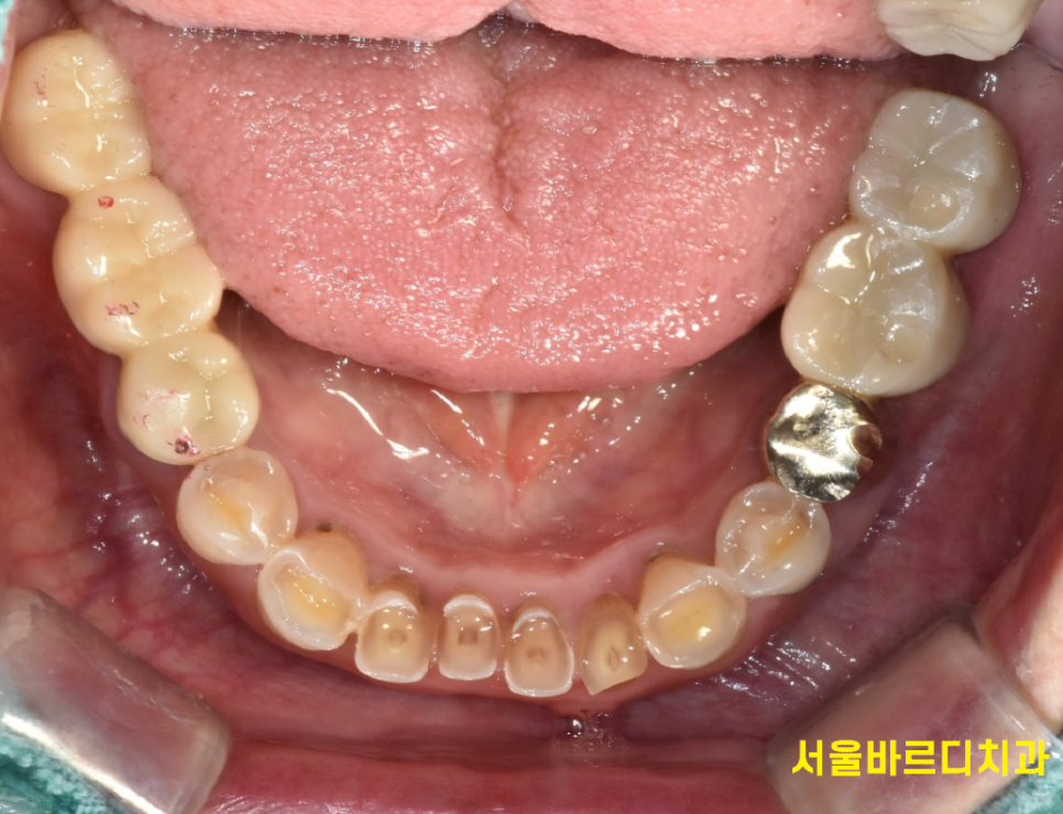 하남 임플란트 치과 주문진에서부터 치료 받으러 오신 환자분 관련 이미지 12