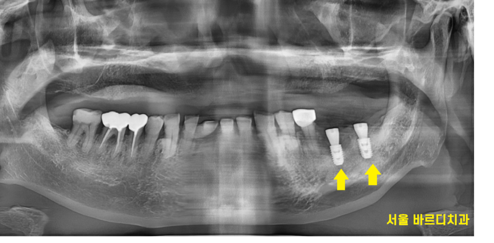 둔촌동 치과 80대 임플란트 가능한가요? 관련 이미지 11