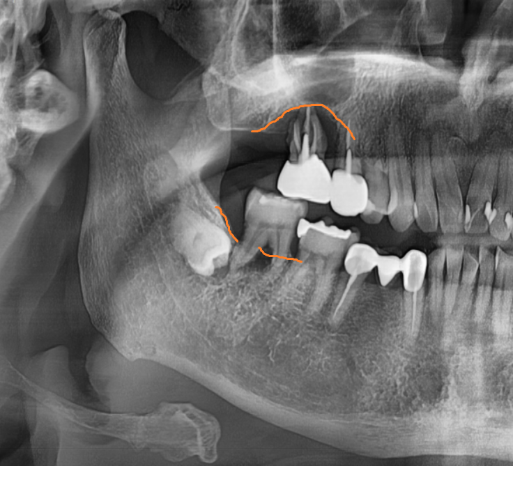 명일역 근처 치과 치아 뿌리 염증이 생겨서 고생하신 사연 관련 이미지 3