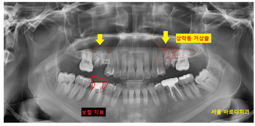 풍산동 치과 임플란트 양쪽 치료 가능한가요? 관련 이미지 8