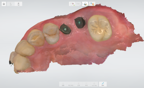 상일동 임플란트 상악동 거상술을 동반한 수술 증례 관련 이미지 12