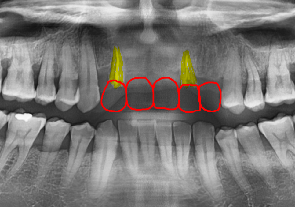앞니 브릿지 부러짐, 이런 상태라면 절대 브릿지 다시 하지 마세요. 관련 이미지 7