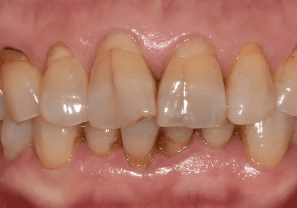 대문니 파절, 앞니에 금이 쩍 갈라졌다면? 딱딱한 음식을 조심해야 하는 이유 관련 이미지 5