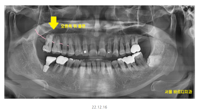 강일동 치과추천 어금니 시림 방치하다 발치하고 임플란트 하신 사연 관련 이미지 2