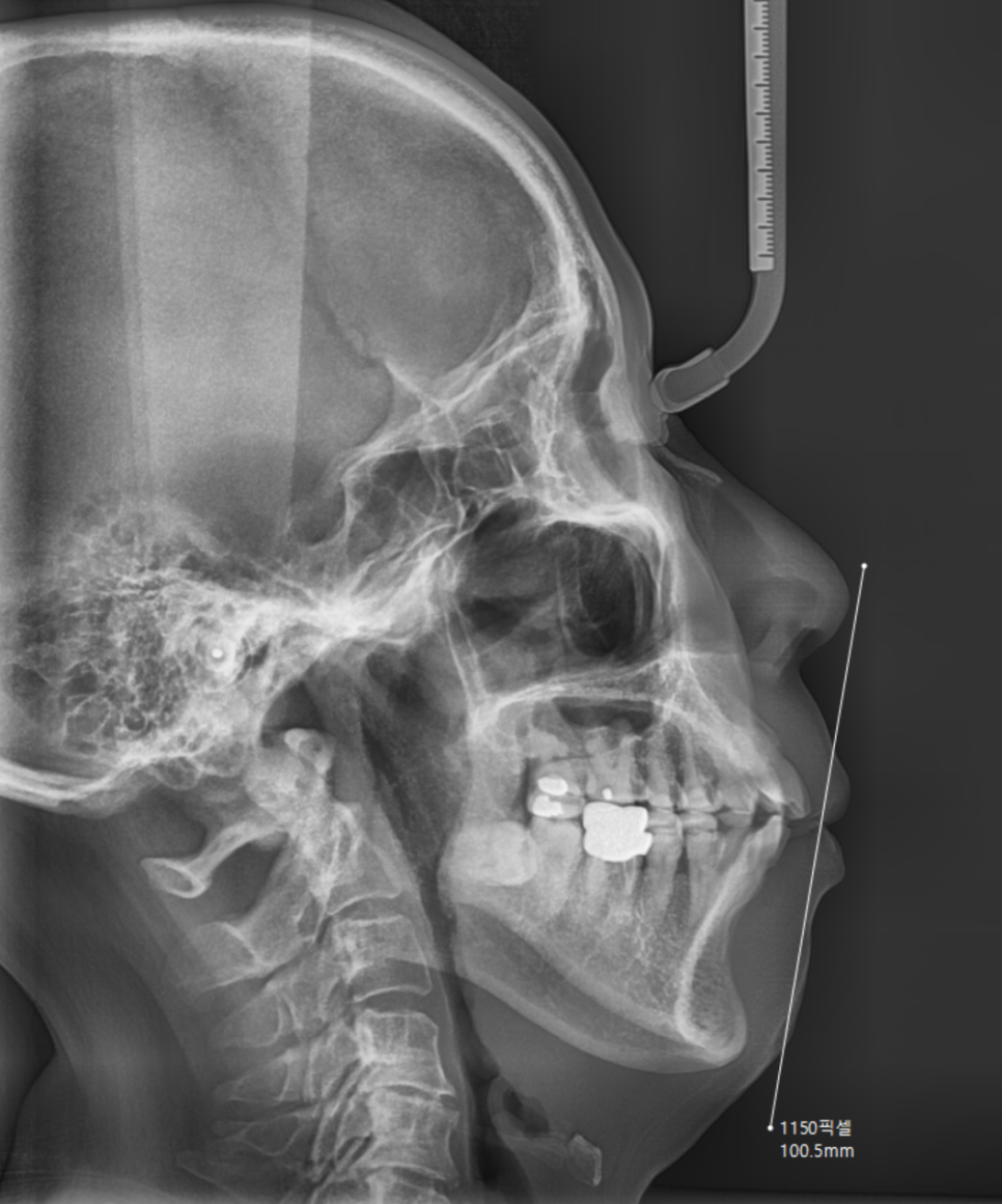 The Moment You Decide on Orthodontic Treatment in Your 50s Is the Fastest image 4