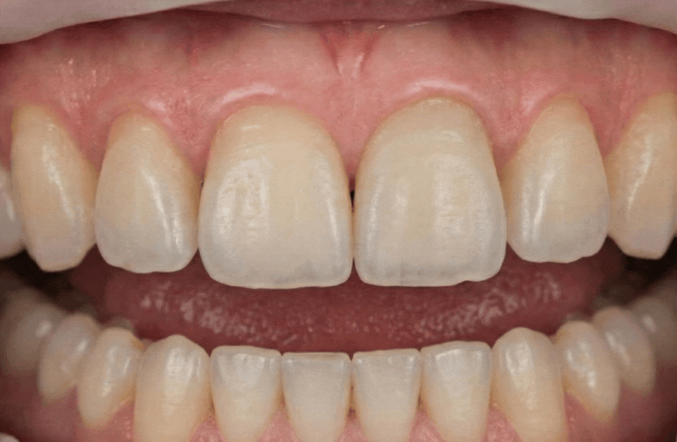 상일동역 라미네이트, 왜 누군가는 부작용을 겪고, 누군가는 10년 넘게 멀쩡할까? 관련 이미지 3