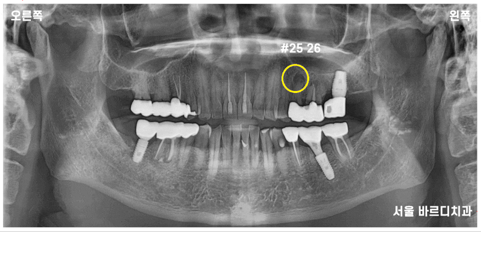 하남 미사 치과 발치 후 당일 임플란트가 가능합니다. 관련 이미지 4