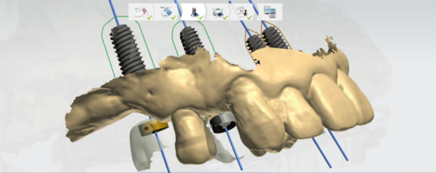 암사동 치과 전악 임플란트 하루만에 끝냈습니다. 관련 이미지 7