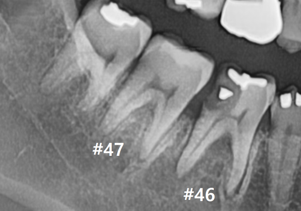 고덕동 어금니 사이 충치, 양치질 누구보다 열심히 하는데 왜 자꾸 생길까요? 관련 이미지 7