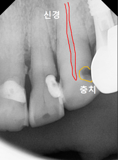앞니 음식물 끼임, 왜 젊을 때보다 더 자주 발생하는 걸까요? 까맣게 변한 앞니 치료 사례 관련 이미지 5