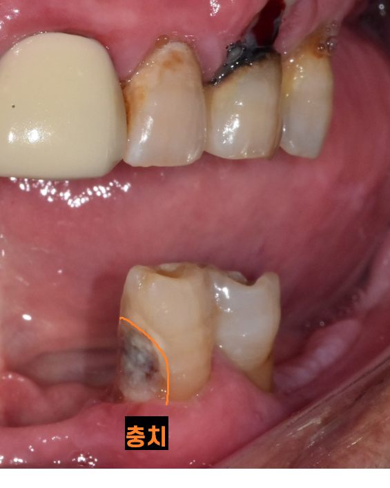 천호동 치과 자연 발치 후 방치된 치아 임플란트 케이스 관련 이미지 5
