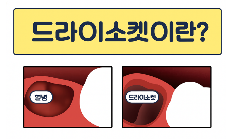 매복 사랑니 발치 후 냄새 드라이소켓 증상일 수 있습니다 . 관련 이미지 2