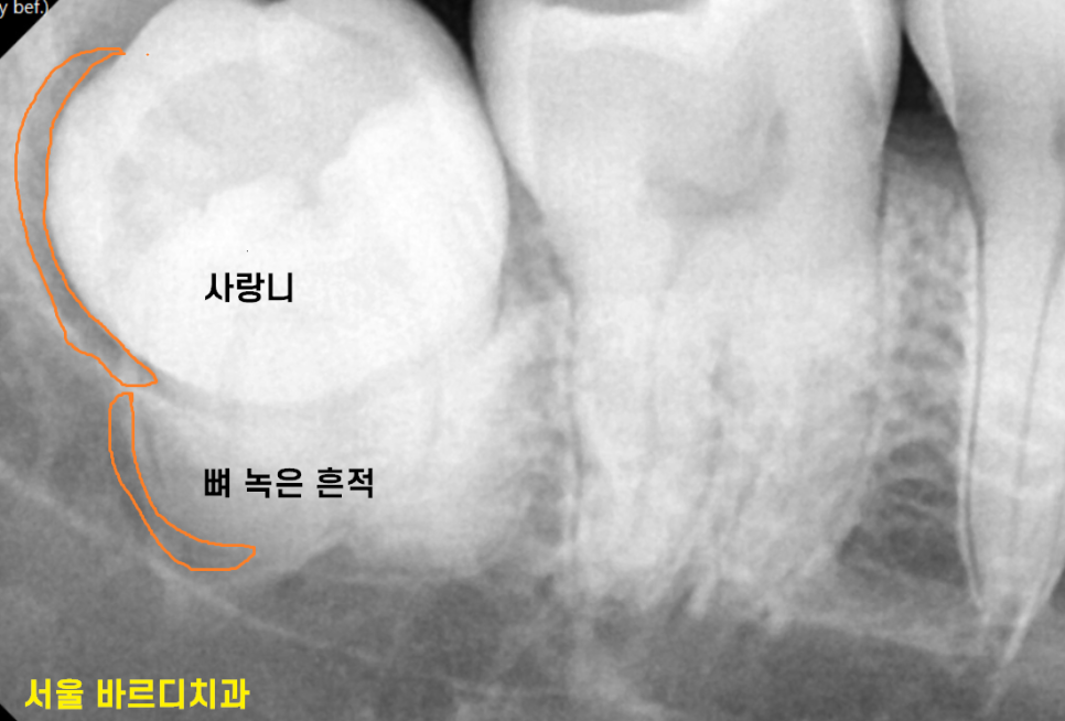 상일동 사랑니 맨날 뽑아야지는 그만!! 매복 치아도 깔끔하게 뽑으세요 관련 이미지 5