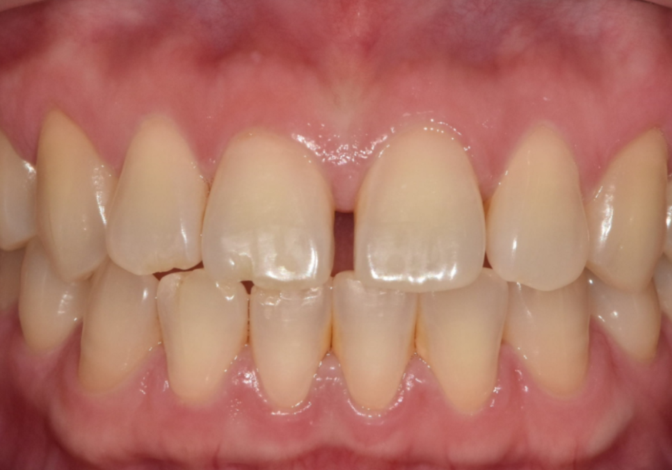 무삭제 라미네이트 적응증, 당신이 미처 몰랐던 시술의 조건을 공개합니다. 관련 이미지 3