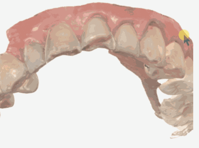 “Taking Impressions” Is Disappearing: What’s Different About Digital Impressions with an Intraoral Scanner? image 5