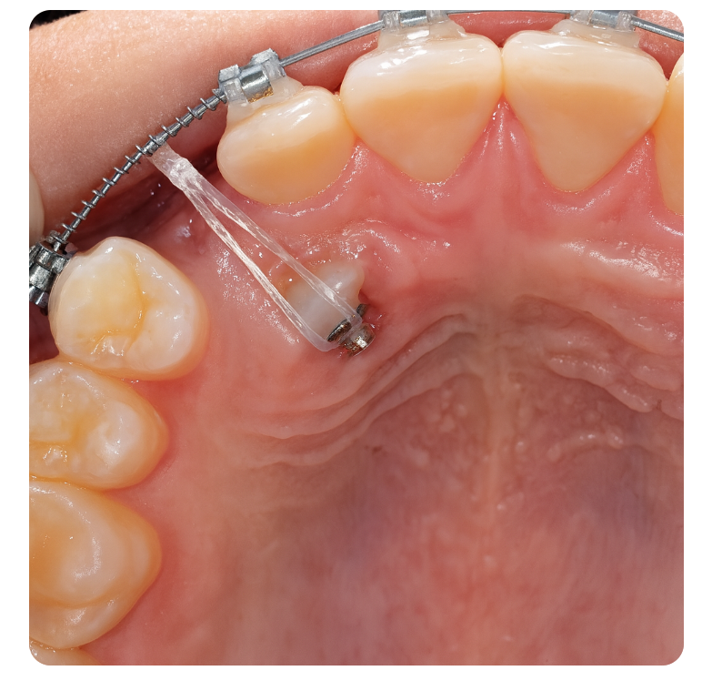 Pediatric Orthodontic Treatment for Impacted Canines Is Needed to Guide Proper Eruption. image 6