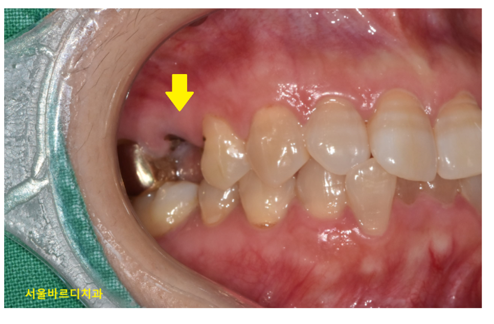 씌운 치아 부러짐 뿌리만 남은 경우 임플란트로 수복하기 관련 이미지 3