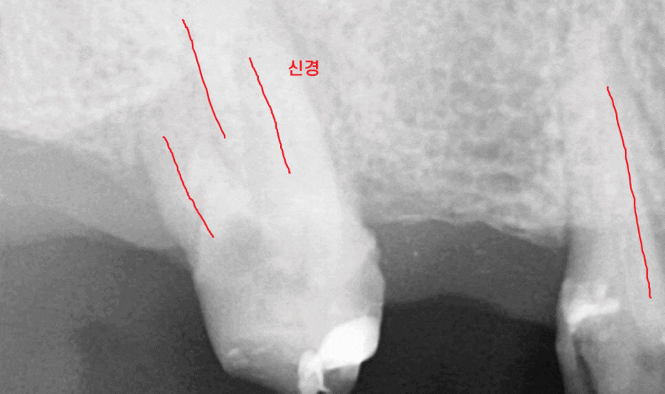 풍산동 치과 임플란트 시술후 통증 부작용은 아닐까? 관련 이미지 1