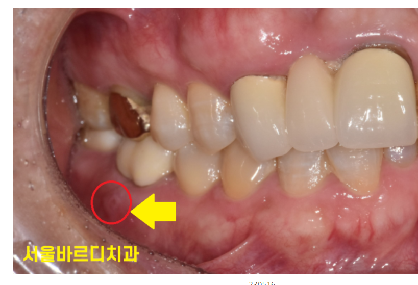 고덕동 치과 심한 치주염에는 oooo 치료가 제격입니다!! 관련 이미지 5