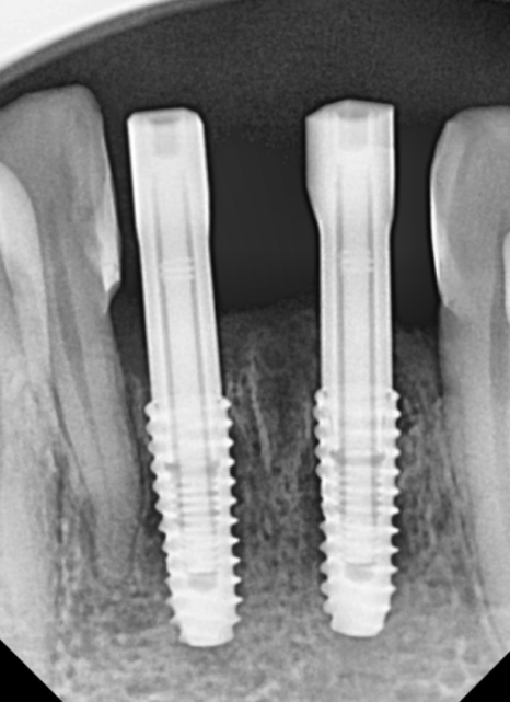 고덕동 스케일링 미루다 앞니 어금니 다 뽑고 임플란트 했습니다. 관련 이미지 19