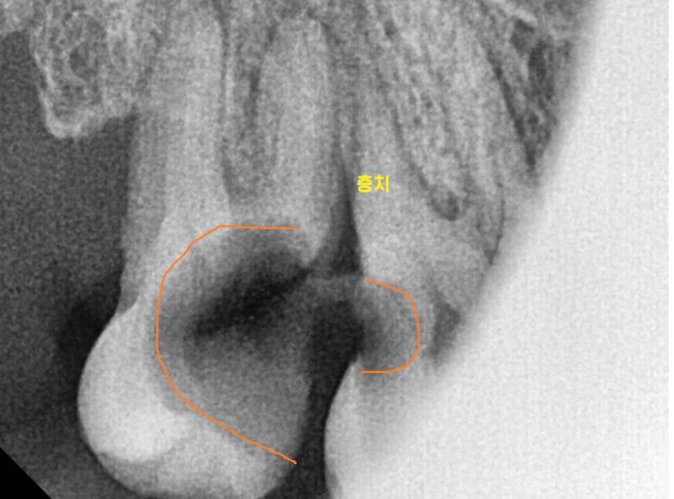 미사 사랑니 뽑아야하나 말아야하나 딱! 정리해드릴께요 관련 이미지 7