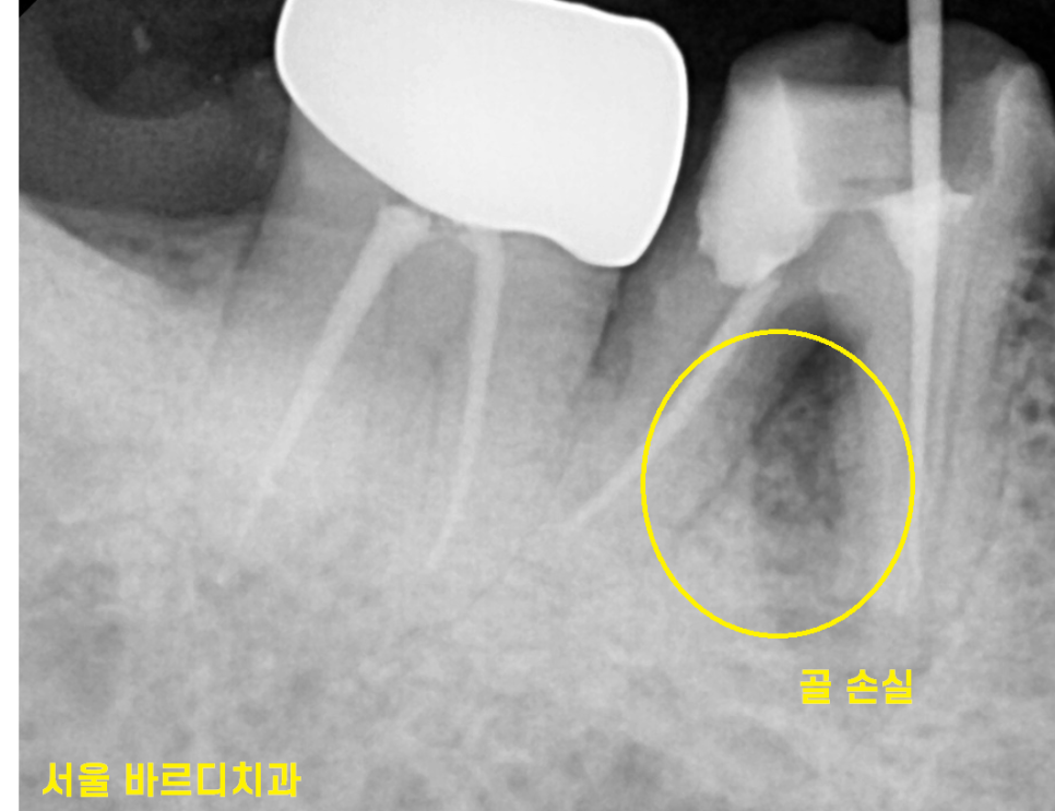 길동 치과 자연치아살리기 mta 비싸지만 사용합니다!! 관련 이미지 3