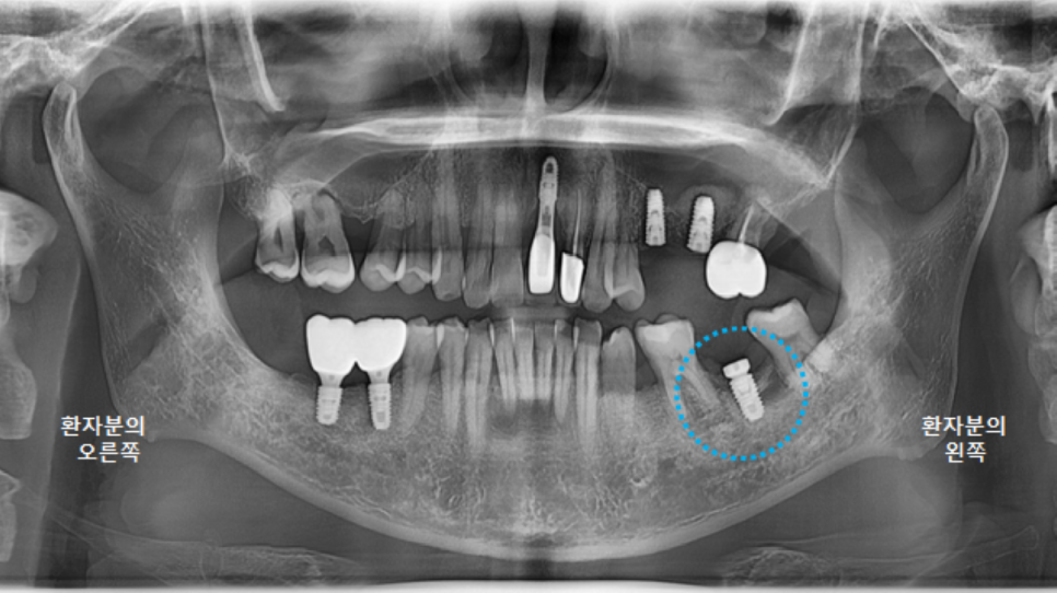 고덕동치과 서울바르디치과 전치부 및 구치부 임플란트 치료증례 #9 관련 이미지 25