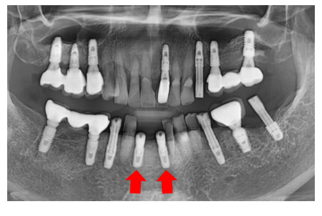 Restored 3 Teeth with Implants After Lower Front Teeth Became Loose and Fell Out image 7