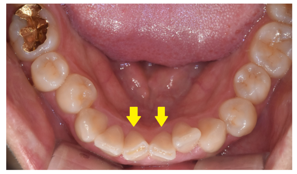 아랫니가 안보여요 과개교합 원인, 문제점 알아보아요! 관련 이미지 4