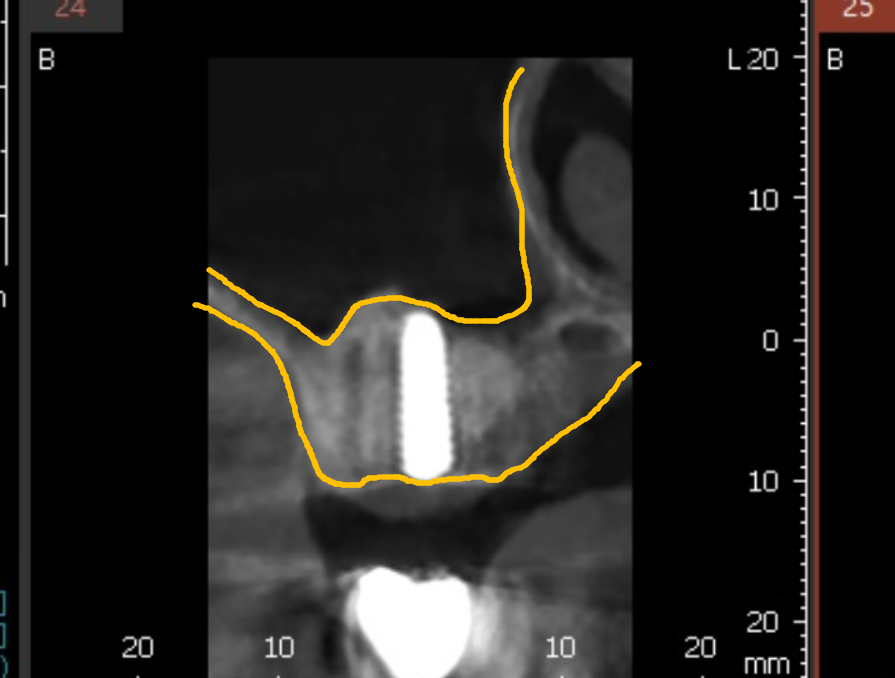 얇은 잇몸뼈, 임플란트 거부 당했다면? 상악동거상술로 해결할 수 있습니다. 관련 이미지 10