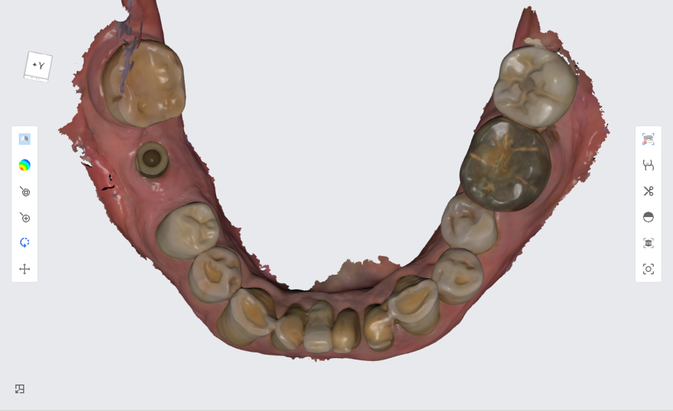 서울바르디치과 상하악 대구치 네비게이션 임플란트 치료증례 #4 관련 이미지 16