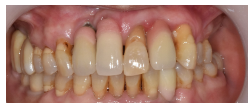 하루만에 임플란트 당일치기가 가능한 조건은?? 관련 이미지 5