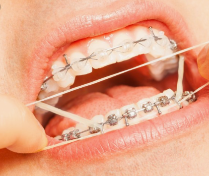 천호동 교정치과 치아교정 고무줄 왜 끼는건가요? 관련 이미지 1