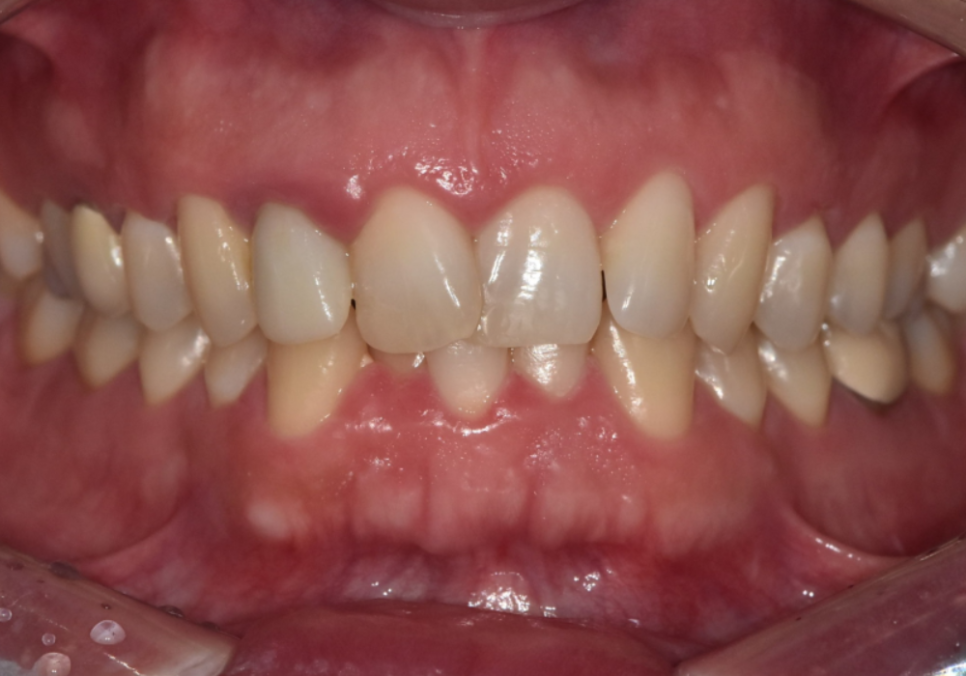 앞니 덧니, 교정은 싫고 시간은 없다면? 라미네이트로 해결한 사례 관련 이미지 1