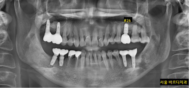 미사역 임플란트 상악동염으로 치아를 발치한 사연 관련 이미지 9