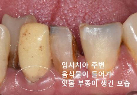 Honestly, Can an Unbroken Temporary Tooth Be Used Without a Crown? image 5
