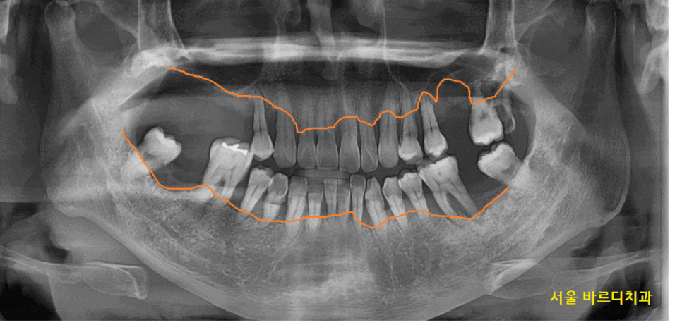 길동 치과 임플란트 뼈이식 흡연 관련 있을까? 관련 이미지 1